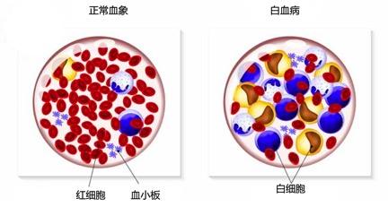 甲醛檢測機構告訴你甲醛與白血病之間有著怎樣的聯(lián)系